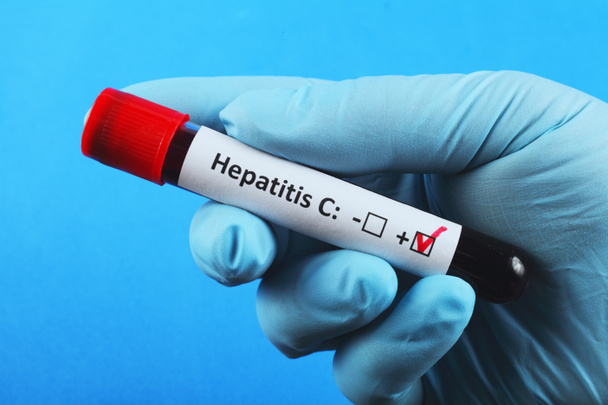 Vacuüm reageerbuis met bloed in de hand van de dokter. bloedtest op hepatitis C. Blauwe achtergrond. - Foto, afbeelding