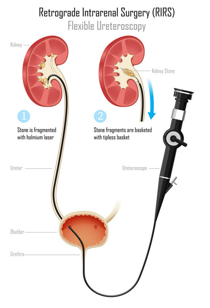 tratamento de pedra renal com ureteroscópio flexível
 - Vetor, Imagem