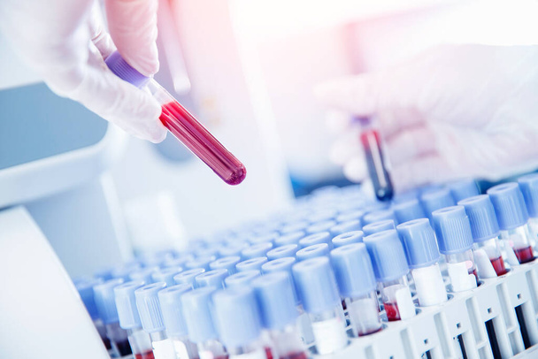 Travailleur de laboratoire préparant le sang de test pour la détection des anticorps et des infections Corona virus
 - Photo, image