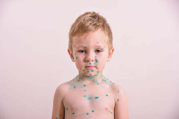 Young toddler,boy with chickenpox. Sick child with chickenpox. Varicella virus or Chickenpox bubble rash on child body and face - Photo, Image