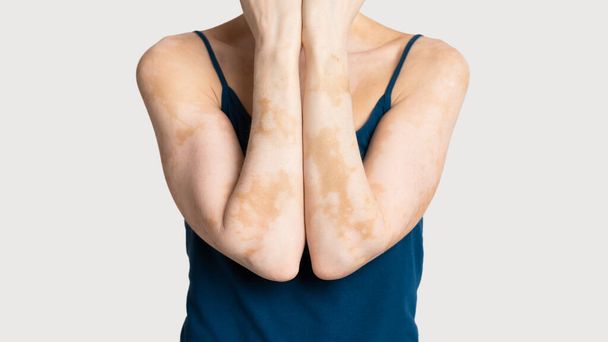 メラニンの皮膚の状態の損失を持つ女性のトリミング - 写真・画像