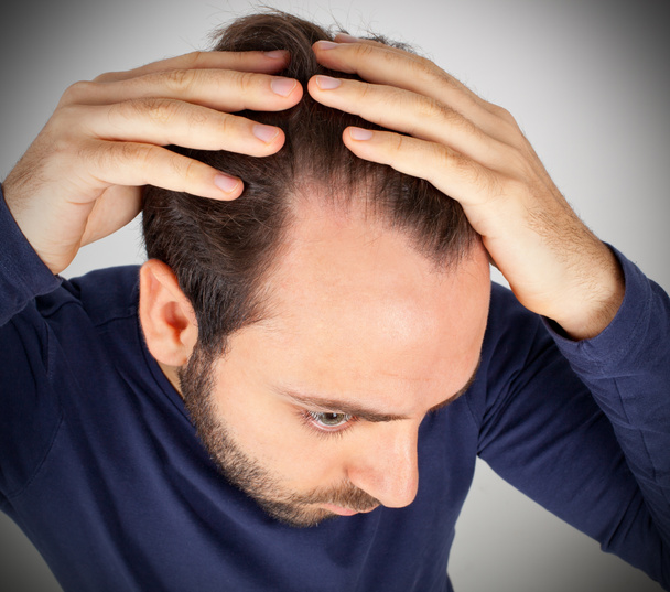 Homem controla a perda de cabelo
 - Foto, Imagem