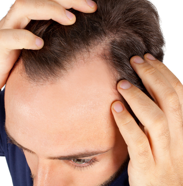Man controls hair loss - Photo, Image