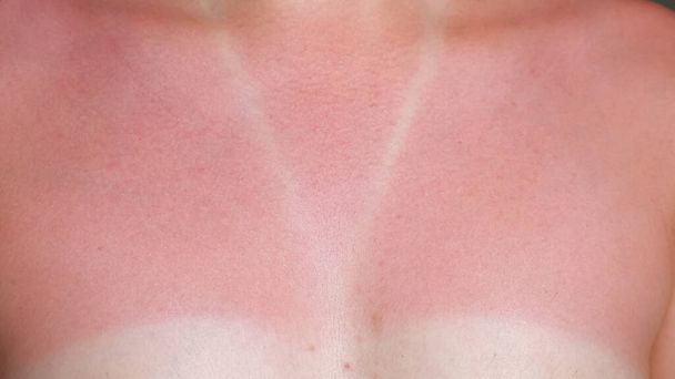 mujer joven desnuda quemado por el sol rojo pecho y cuello primer plano
 - Foto, Imagen