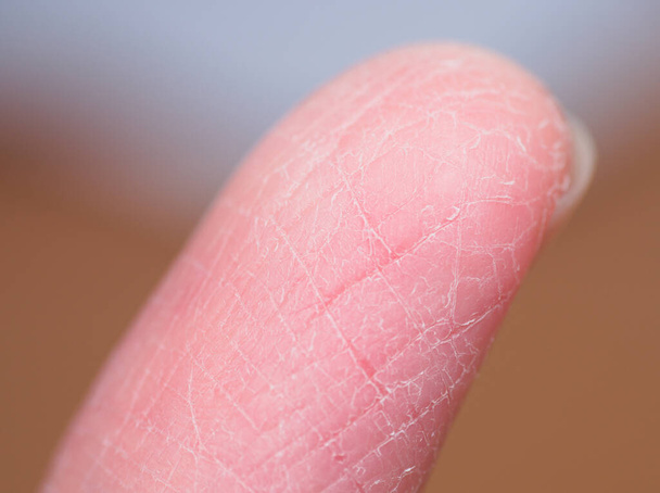επώδυνο σπασμένο δέρμα δακτύλων κατά τη διάρκεια του χειμώνα χωρίς να λαμβάνεται καλή περιποίηση δέρματος κάτω από μακροσκοπική προβολή - Φωτογραφία, εικόνα