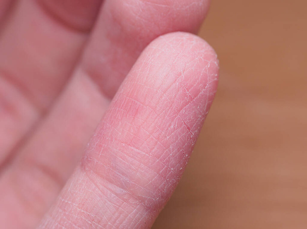 επώδυνο σπασμένο δέρμα δακτύλων κατά τη διάρκεια του χειμώνα χωρίς να λαμβάνεται καλή περιποίηση δέρματος κάτω από μακροσκοπική προβολή - Φωτογραφία, εικόνα