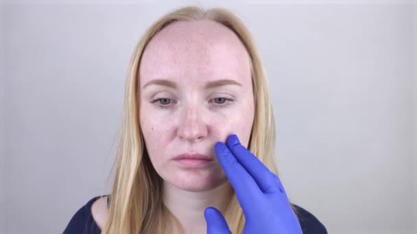 青い医療用手袋の皮膚科医は、脂性肌を検査します。オイリーと問題の肌。にきび、脂性肌と色素沈着とブロンドの女の子の肖像画. - 映像、動画
