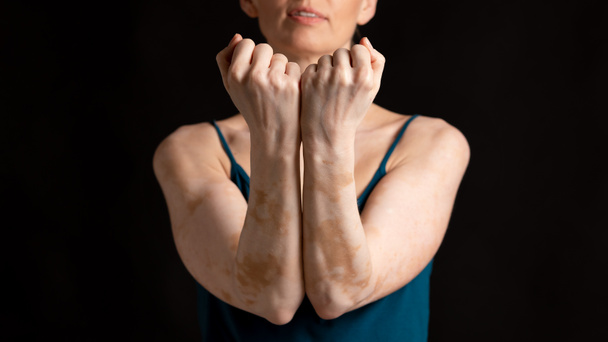 Girl in studio with vitiligo disease and skin trouble - Photo, Image