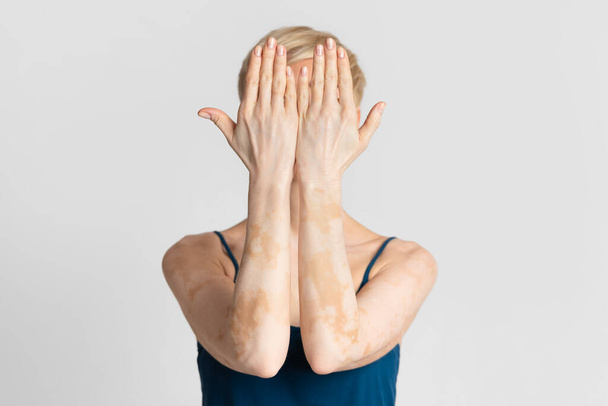 Женщина с бледными пятнами витилиго покрывает лицо
 - Фото, изображение