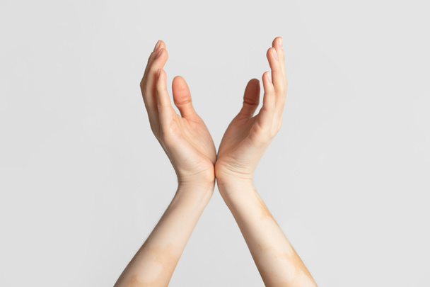 Krooninen ihosairaus Naisten kädet vitiligo täplät
 - Valokuva, kuva