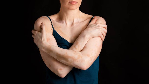 Frau leidet unter chronischem Hautproblem - Foto, Bild