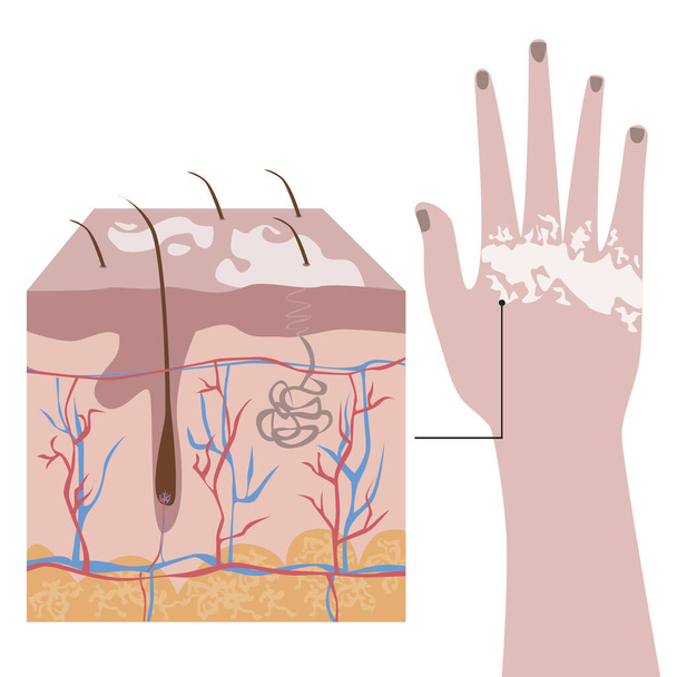 Рука європейської, американської або азійської людини з вітиліго або депігментацією шкіри і заварною шкірою. Плоский векторний стовбур, ізольований на білому тлі як концепція структури шкіри з вітиліго. - Вектор, зображення
