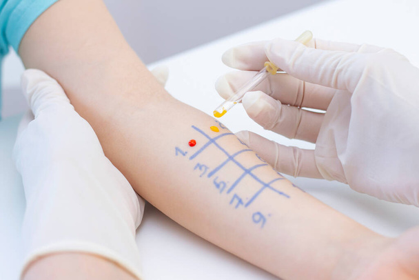 Allergen test on hand. child undergoing procedure of allergen skin test in clinic. - Photo, image