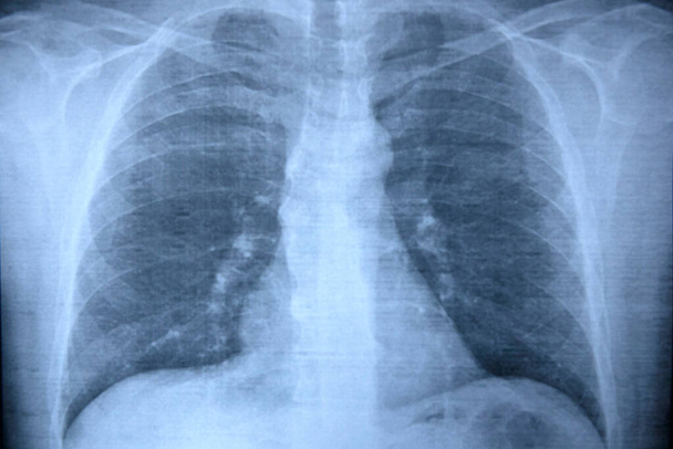 Röntgen der Lungen einer kranken Person. Gesundheits- und Medizinkonzept - Foto, Bild
