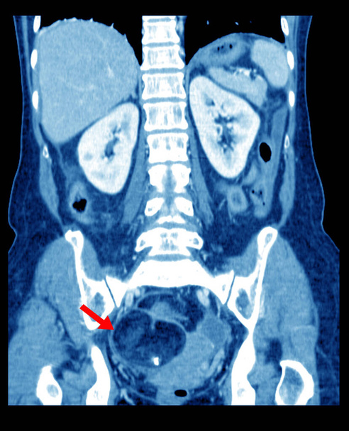 CT Masse graisseuse de l'abdomen entier avec calcification à l'adnexa Rt, représentant le kyste dermoïde sur le point de flèche rouge
. - Photo, image
