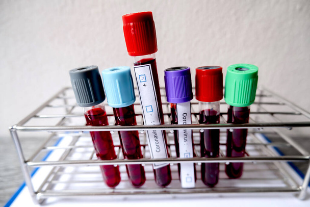 Profesjonalni lekarze wykonują badania COVID-19 z próbek badań krwi w celu zdiagnozowania analizy zakażeń wirusem wieńcowym oraz pobierania próbek z koncepcji medycznych chorób zakaźnych i opieki zdrowotnej.. - Zdjęcie, obraz