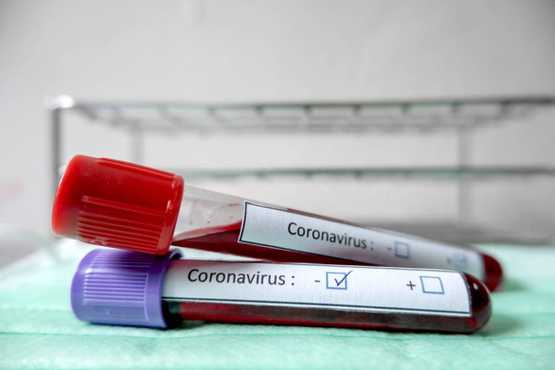 Επαγγελματίες γιατροί εκτελούν εξετάσεις COVID-19 από δείγματα των εξετάσεων αίματος για τη διάγνωση των λοιμώξεων του στεφανιαίου ιού ανάλυση και δειγματοληψία των λοιμωδών νόσων ιατρικές έννοιες και την υγειονομική περίθαλψη. - Φωτογραφία, εικόνα