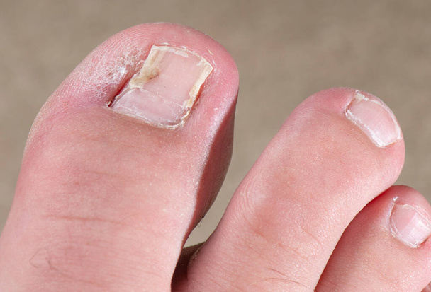 Ameliyat sonrası iyileşmekte olan eski bir ayak tırnağı. Cerrahi işlemden bu yana aylar geçti ve ayak parmağında artık bakteri ya da mantar enfeksiyonu yok. Tırnak yatağı ile ayak parmağı arasındaki büyük boşluklar hala duruyor. - Fotoğraf, Görsel