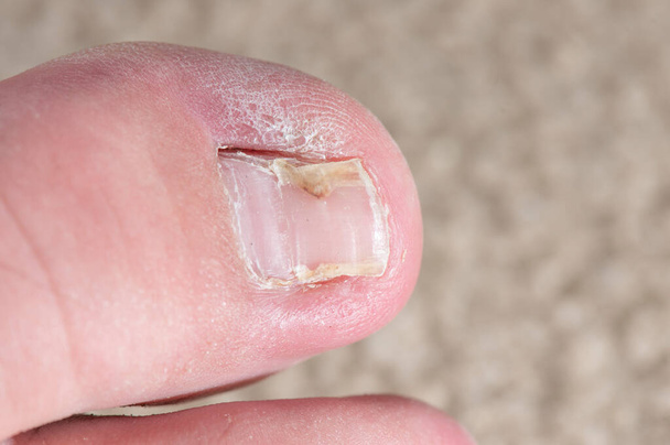 手術から回復する前に成長した歯の爪。手術から数ヶ月が経過し、つま先はもはや任意の細菌や真菌感染症を持っていません,しかし、爪床とつま先の間の大きなギャップはまだ残っています, remna - 写真・画像