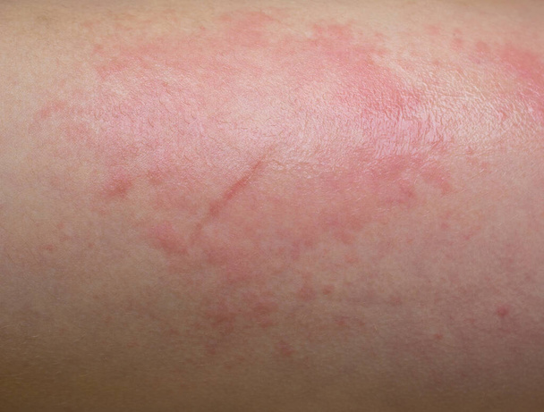 Réaction allergique cutanée. Rougeur de la peau. Allergie. Macro
 - Photo, image