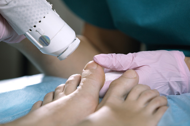 Jalkahoitaja hoitaa onychomycosis laserilla
 - Valokuva, kuva