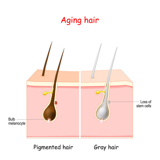 aging process through gray hair. Pigmanted and gray hair. The stem cells at the hair follicles produce melanocytes, that produce and store pigment. The death of the melanocyte stem cells causes the onset of graying. - Vector, Image