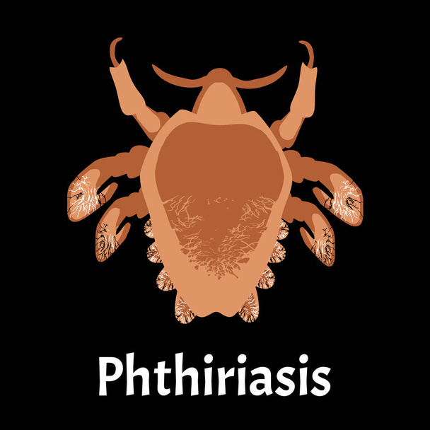 Parasitic diseases of Phthiriasis. Pediculosis pubis. Pubic lice structure. Sexually transmitted diseases. Infographics. Vector illustration on isolated background. - Vector, Image