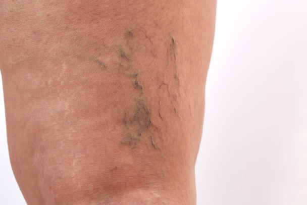 nohy čtyřicetileté ženy s striemi, celulitidou a křečovými žilami zblízka - Fotografie, Obrázek