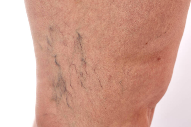 piernas de una mujer de 40 años con estrías, celulitis y venas varicosas de cerca
 - Foto, Imagen