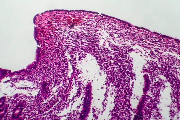Hiperplasia endometrial, micrografia de luz, foto ao microscópio
 - Foto, Imagem