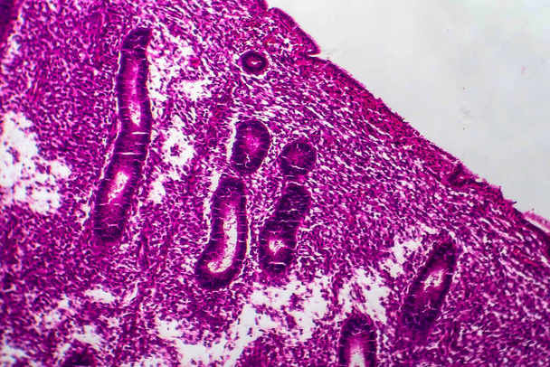 Ендометріальна гіперплазія, легкий мікрограф, фото під мікроскопом
 - Фото, зображення