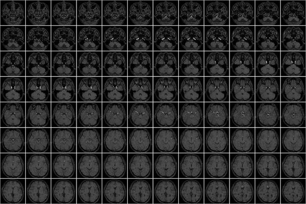 Miniatura zobrazující sérii snímků MRI hlavy - Fotografie, Obrázek