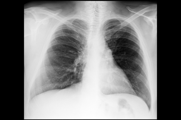 Male chest x-ray - Raio x tórax masculino - Fotoğraf, Görsel
