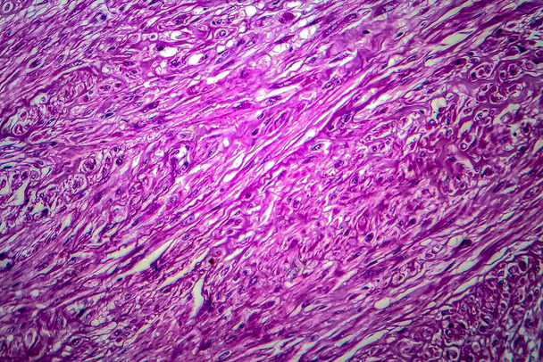 Léiomyome utérin, également connu sous le nom de fibromes, une tumeur bénigne du muscle lisse de l'utérus, micrographie photonique, photo au microscope
 - Photo, image
