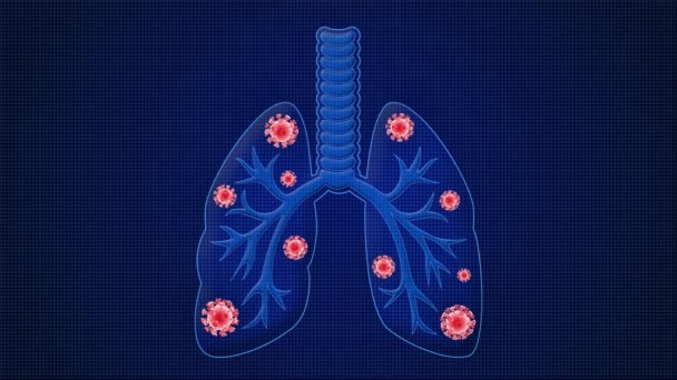 Animation médicale de poumons infectés par le coronavirus du CoV-2 du SRAS causant des difficultés respiratoires ou une pneumonie ou une autre maladie pulmonaire liée à la coagulation 19. Animation médicale 3D. Animation bouclable. 3d
 - Séquence, vidéo