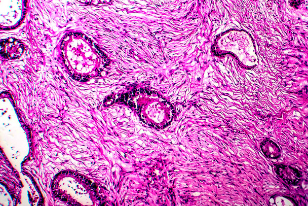 Рак ядра, легкий мікрограф
 - Фото, зображення