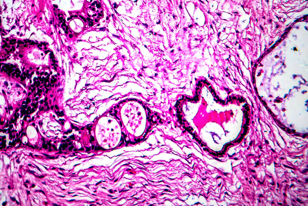 Baarmoederhalskanker, lichtmicrograaf - Foto, afbeelding