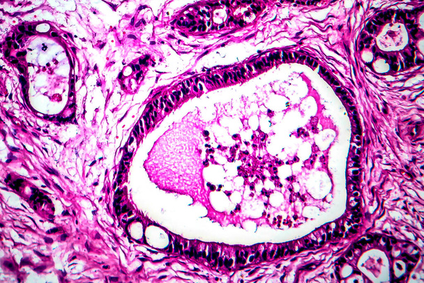 Cáncer uterino, micrografía ligera
 - Foto, Imagen