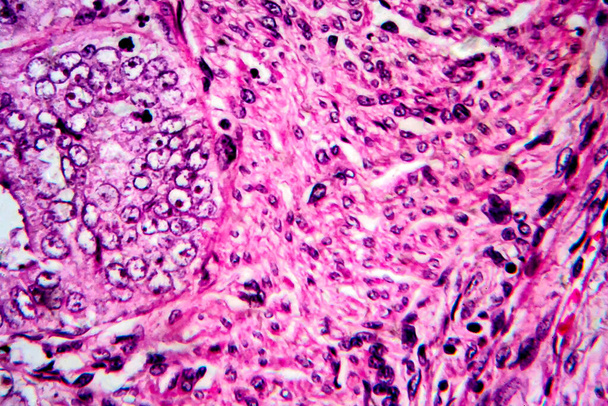 Gruczolakorak endometrium, mikrograf światła - Zdjęcie, obraz