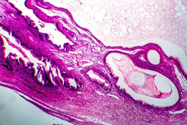 Schleimhautzystadenom der Eierstöcke, ein gutartiger Tumor der Eierstöcke, Lichtmikroskopie, Foto unter dem Mikroskop - Foto, Bild