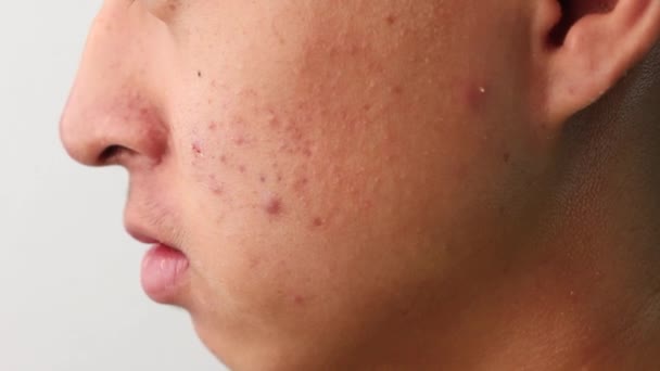Close-up o rosto lateral do adolescente asiático com acne e problemas de pele. Conceitos de saúde e cuidados com a pele
. - Filmagem, Vídeo