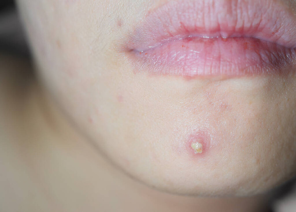 Young woman with acne problem,Close up of acne on the face skin caused by the hormone and the scars, acne inflammation . - Photo, Image