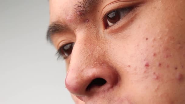 Close-up gezicht van Aziatische tiener jongen met acne en probleem huid. Huidverzorgingsconcept. - Video