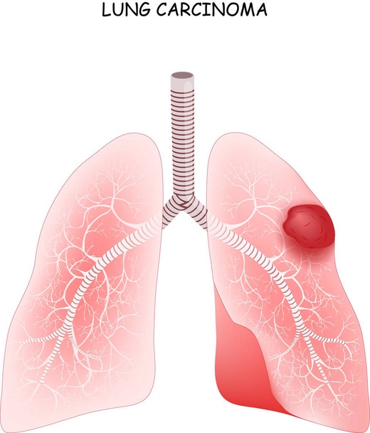 Rak płuc. rak jest nowotworem złośliwym płuc. ilustracja wektora do celów medycznych - Wektor, obraz