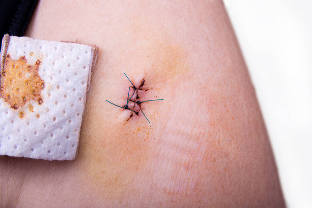 Trois points de suture sur un bras de femme après l'opération
 - Photo, image