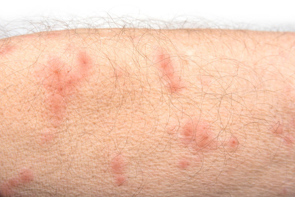 皮膚病は男性の腕に発疹 - 写真・画像