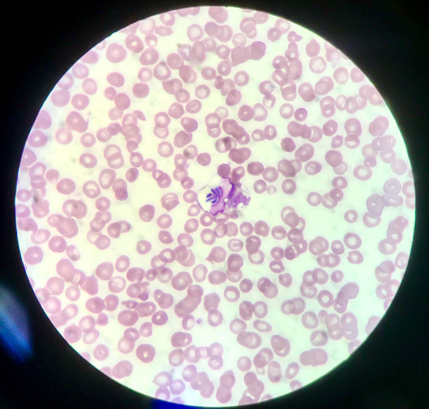 Infection fongique dans les globules blancs fond de la science médicale
. - Photo, image