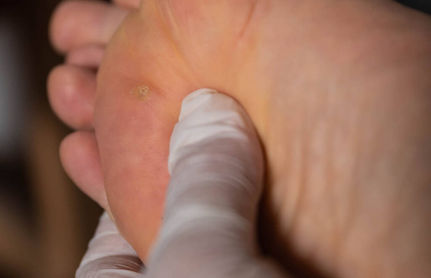 Primer plano de un verrugoso pie de hombre caucásico. Los dedos de la mano inspeccionan la piel cerca del área infectada
. - Foto, imagen