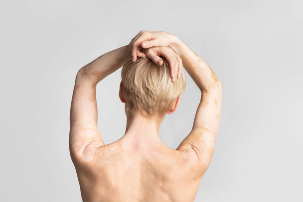 Naked woman with vitiligo with hands up - Zdjęcie, obraz