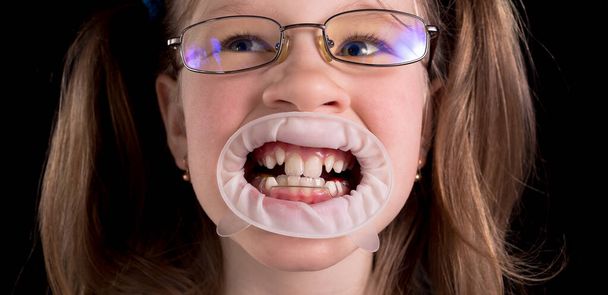 Kleines Mädchen zeigt schiefe Zähne auf schwarzem Hintergrund. Studiofoto. - Foto, Bild